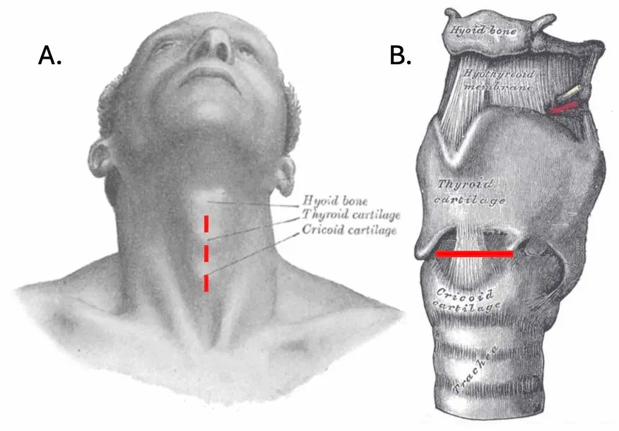 Illustration anatomique de la technique d'incision en deux temps pour une cricothyroïdotomie chirurgicale.