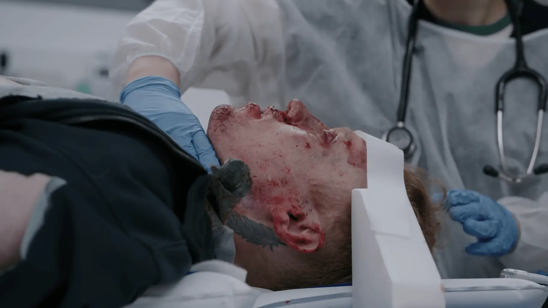 Patient se présentant avec un traumatisme facial massif et une épistaxis après une collision en trottinette électrique.