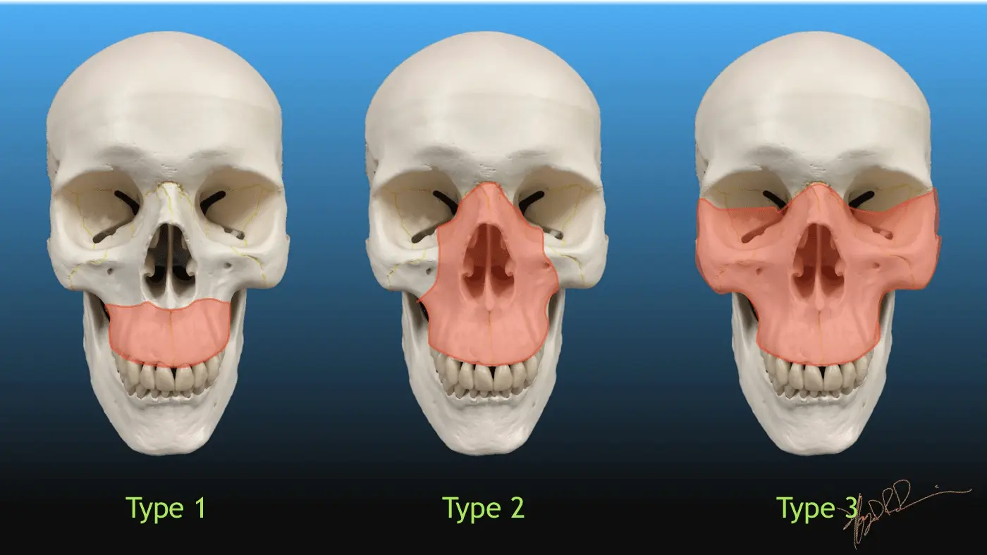 Illustration de la classification des fractures de Le Fort I, II et III.