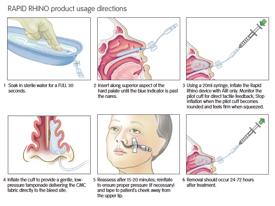 Mode d'emploi du Rapid Rhino illustrant le trempage du dispositif, son insertion le long du plancher des fosses nasales et le gonflage à l'air à l'aide d'une seringue de 20 ml.