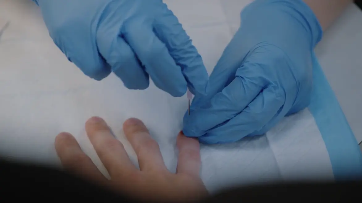 Verwendung einer Kanüle zur Durchführung einer Nageltrepanation bei einem subungualen Hämatom.