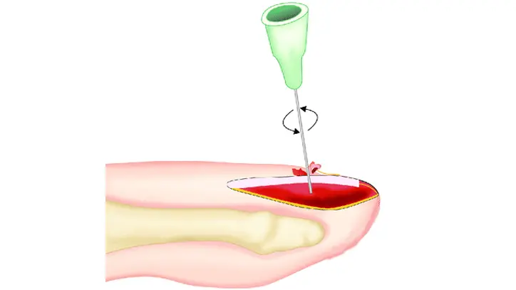 Querschnittsdiagramm der Nageltrepanation unter Anwendung der Nadelrotationstechnik.