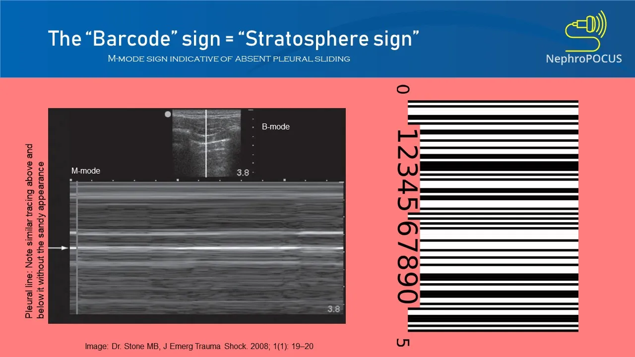 Mode M en échographie démontrant le « signe du code-barres » (ou de la stratosphère).