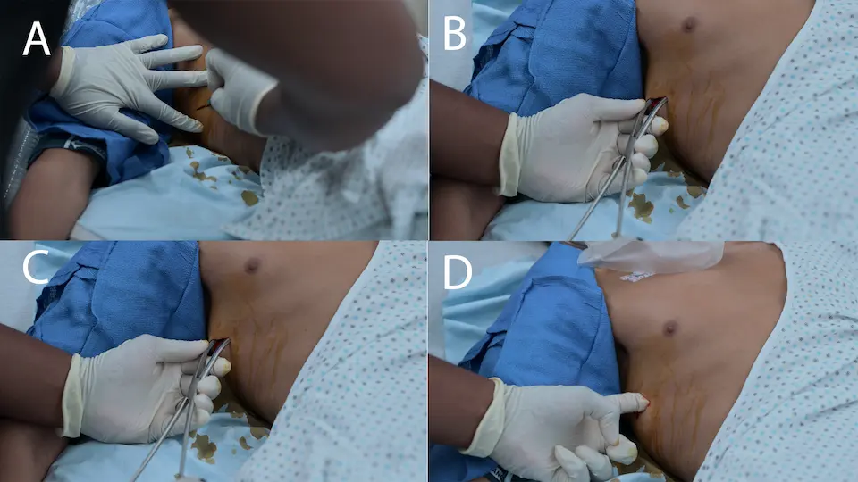 Séquence rapide en quatre étapes d'une thoracostomie au doigt en urgence pour décomprimer un pneumothorax suffocant droit.