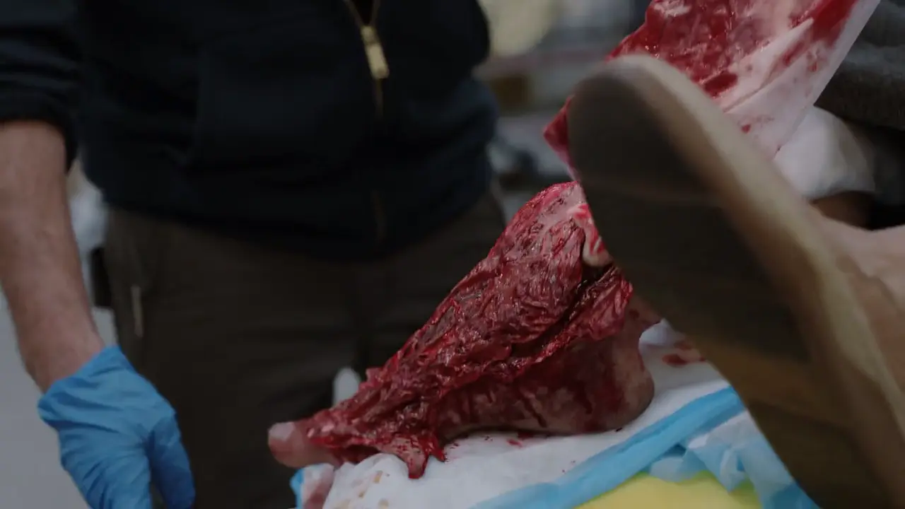 Type III Open Fracture