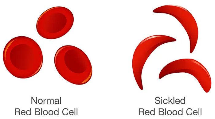 Comparaison entre des globules rouges biconcaves normaux et des globules rouges falciformes (en forme de faucille) anormaux.