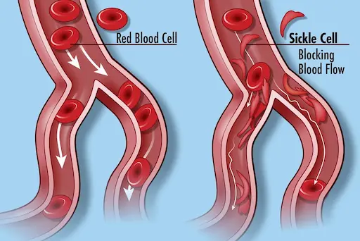 Schéma illustrant une crise vaso-occlusive où les globules rouges falciformes bloquent physiquement le flux sanguin au niveau d'une bifurcation vasculaire.
