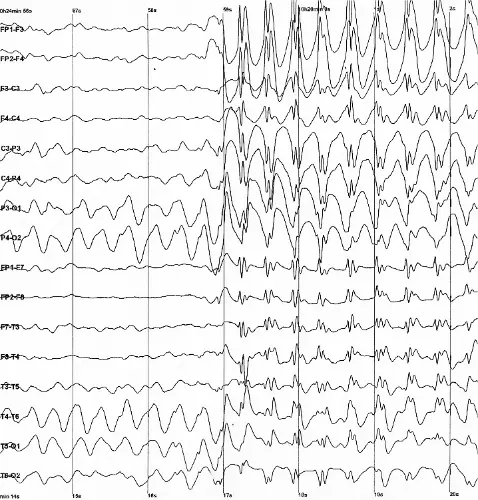 Tracé EEG démontrant l'apparition de décharges continues de pointes-ondes généralisées, caractéristiques de l'état de mal épileptique.