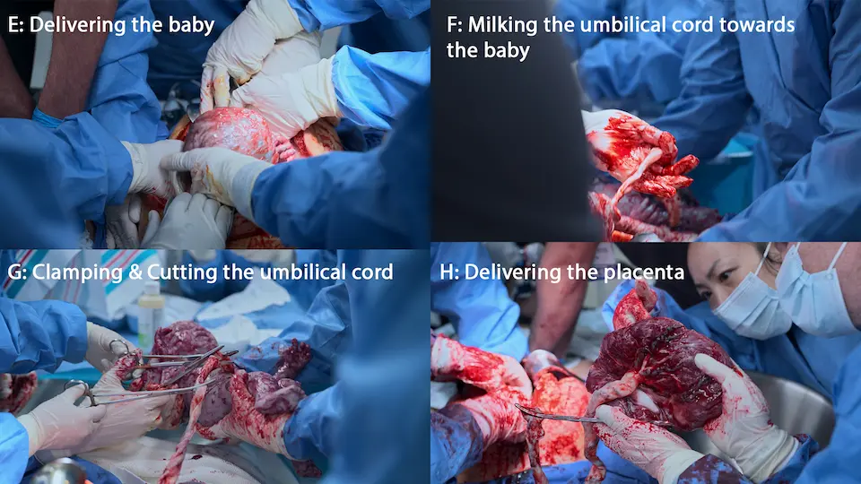Étapes suivantes de l'hystérotomie de sauvetage : extraction de l'enfant et du placenta.