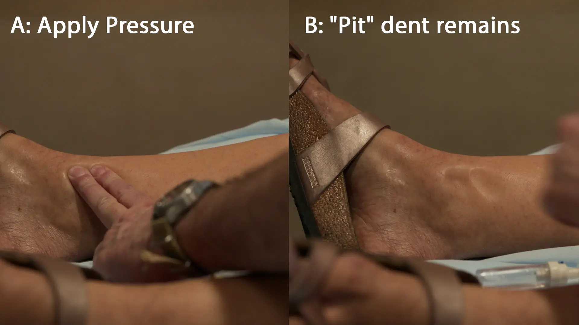 Démonstration d'un œdème sévère prenant le godet sur le membre inférieur de la patiente.