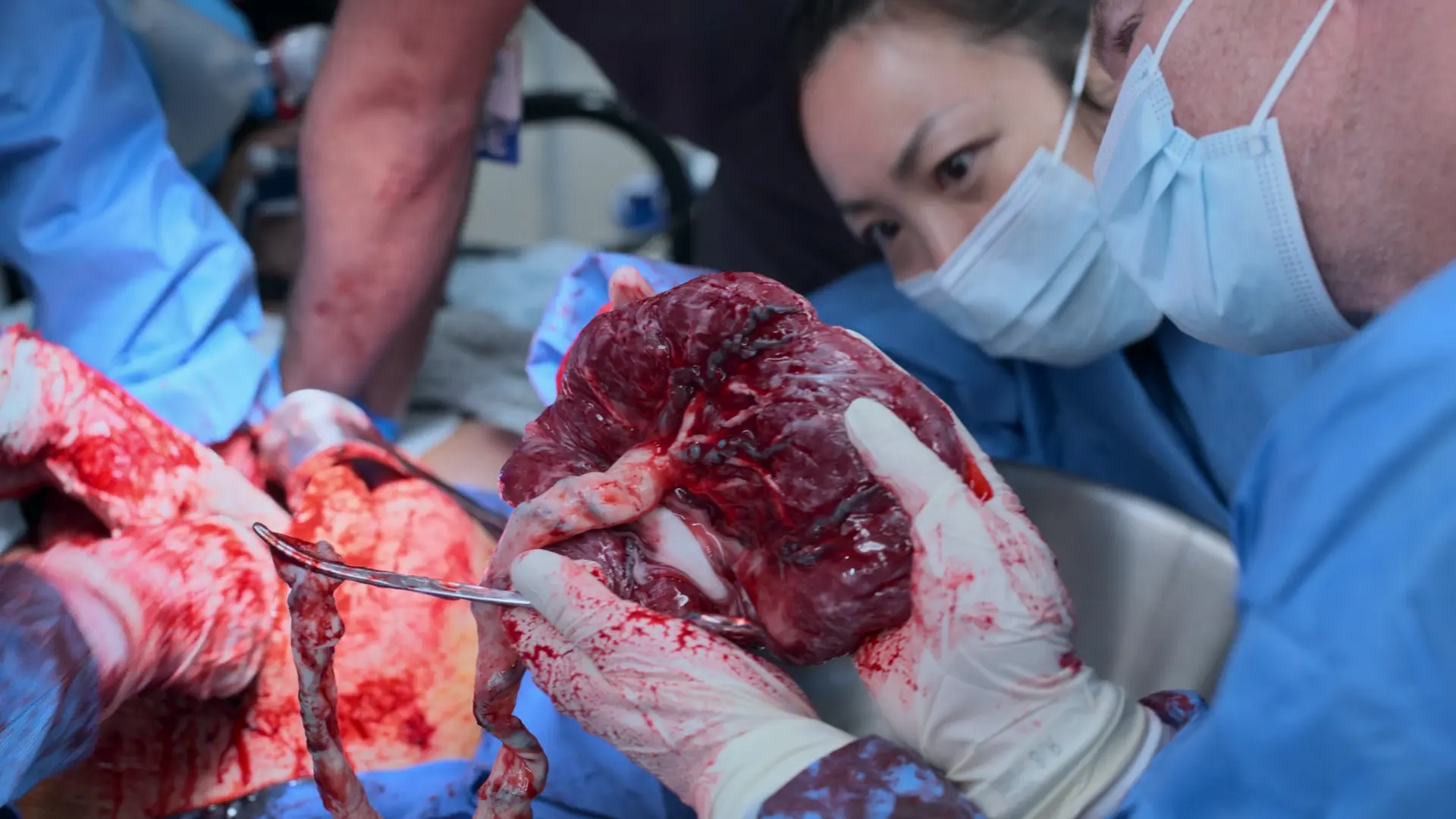 L'IDE en obstétrique Garvin inspectant la surface maternelle du placenta nouvellement délivré pour confirmer qu'il est totalement intact.