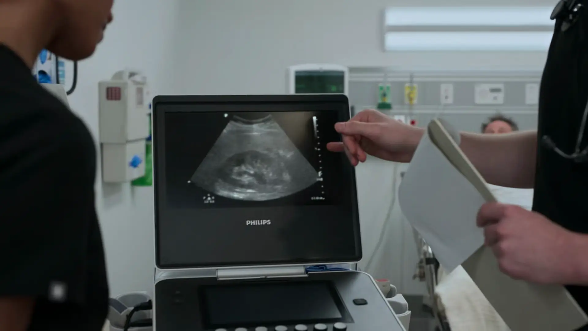 Échographie rénale (POCUS) montrant une légère hydronéphrose gauche.