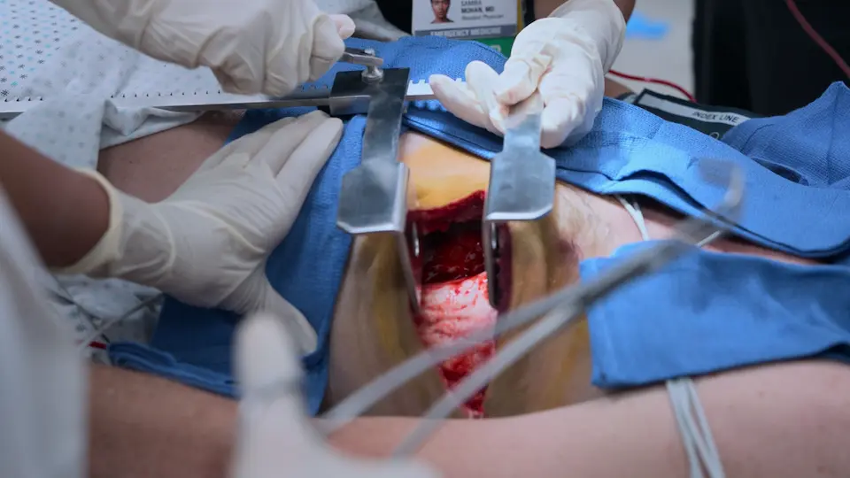 Thoracotomie de réanimation aux urgences avec application d'un clamp de Satinsky sur l'aorte descendante.