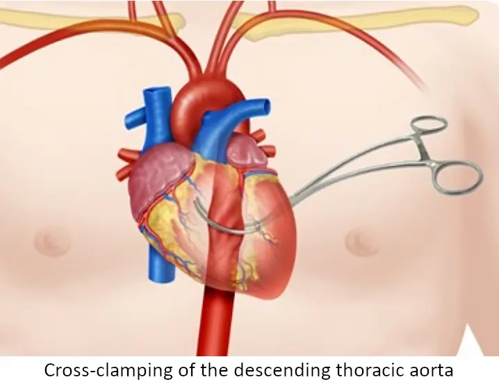 Illustration schématique démontrant le clampage de l'aorte thoracique descendante.