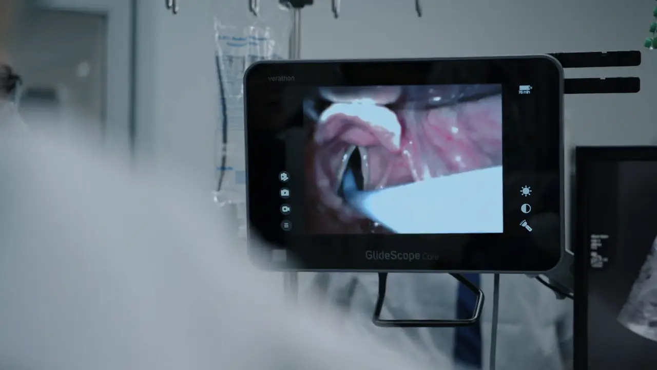 Intubation using a bougie with a distal bend (Coudé tip).