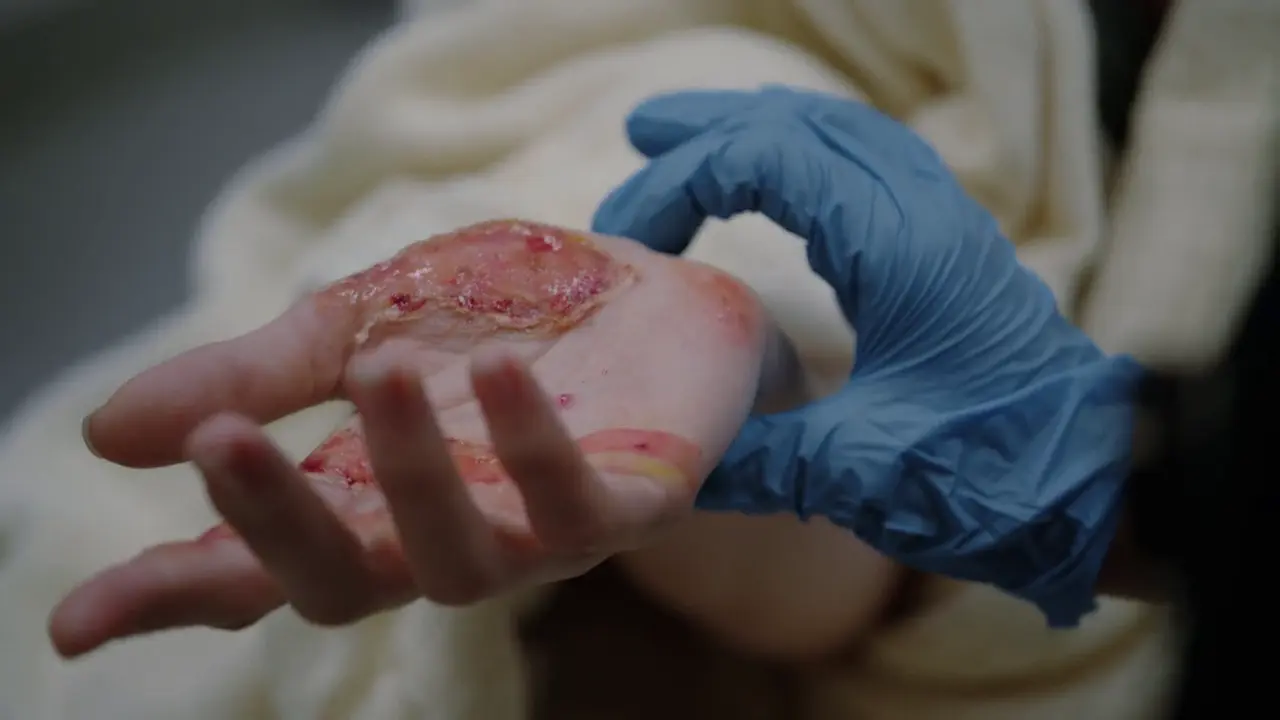 Application of saline dressing to burn